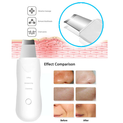 Ultrasonic Skin Scrubber – Blackhead Remover & Exfoliator