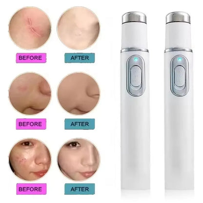 Blue Light Laser Pen – Anti-Acne, Spots & Visible Veins
