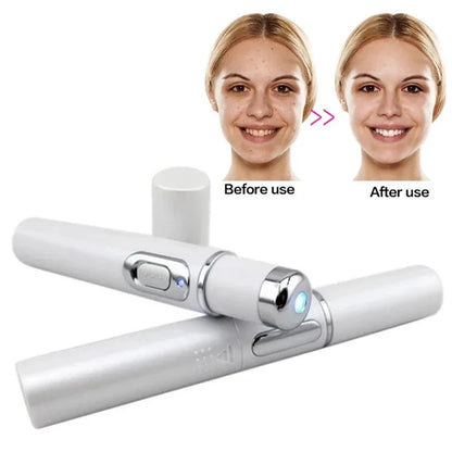 Blue Light Laser Pen – Anti-Acne, Spots & Visible Veins