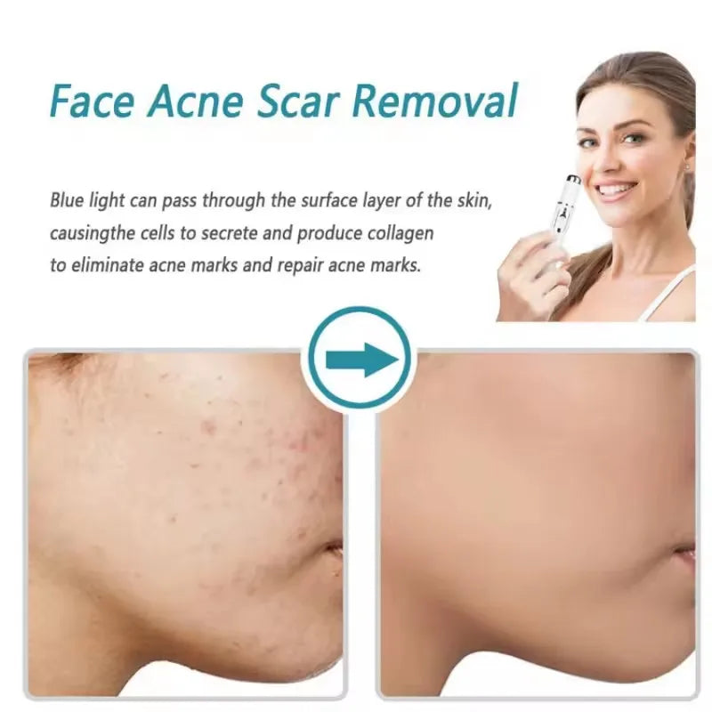 Blue Light Laser Pen – Anti-Acne, Spots & Visible Veins